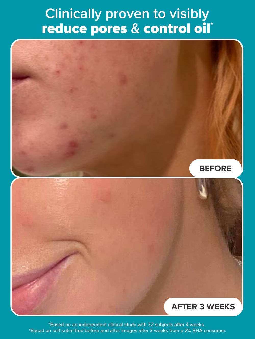 Paulas Choice Skin Perfecting 2% BHA Exfoliating Toner