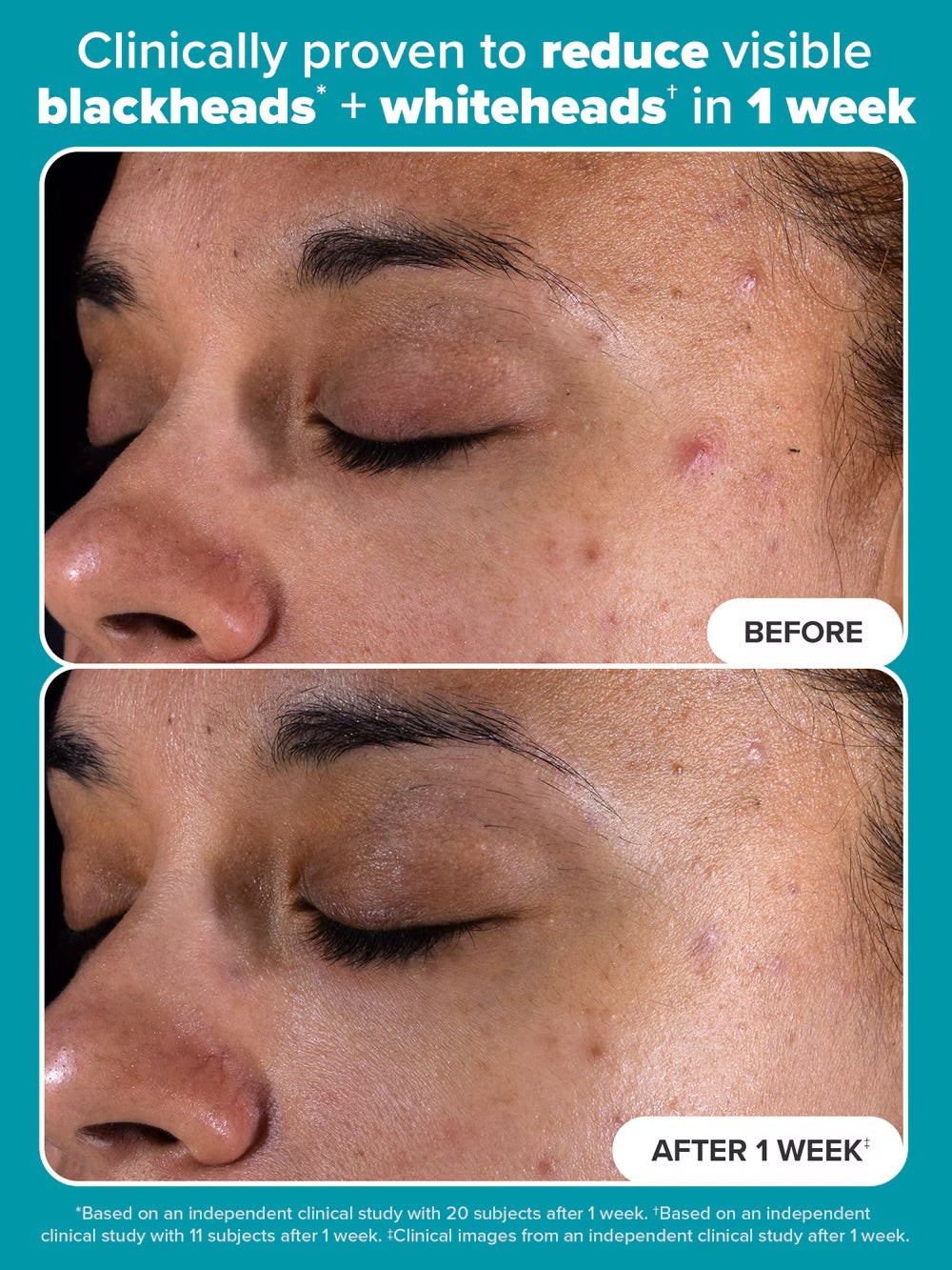 Paulas Choice Skin Perfecting 2% BHA Exfoliating Toner