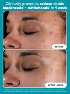 Paulas Choice Skin Perfecting 2% BHA Exfoliating Toner